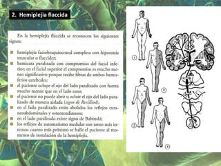 2. Hemiplejia flaccida
 