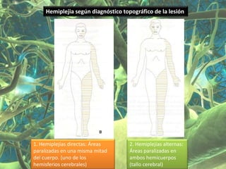Hemiplejia según diagnóstico topográfico de la lesión




1. Hemiplejías directas: Áreas       2. Hemiplejías alternas:
paralizadas en una misma mitad       Áreas paralizadas en
del cuerpo. (uno de los              ambos hemicuerpos
hemisferios cerebrales)              (tallo cerebral)
 