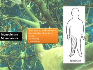 Trastorno de motilidad de un
               solo miembro. Braquial o
Monoplejía o   crural-
Monoparesia    -Cerebrales
               - Medulares
 