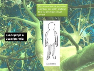 Afección motora de los cuatro
                 miembros por lesión bilateral
                 de la vía piramidal a nivel
                 cervical




Cuadriplejía o
Cuadriparesia
 