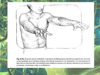 Presentación Sindrome Piramidal