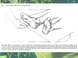 Presentación Sindrome Piramidal