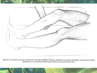 Presentación Sindrome Piramidal