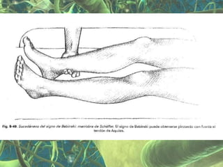 Presentación Sindrome Piramidal