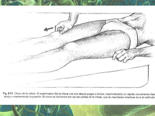 Presentación Sindrome Piramidal