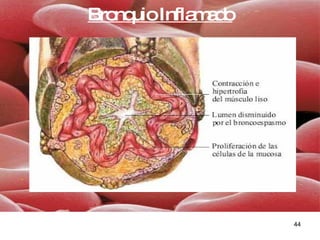 Bronquio Inflamado 