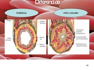 Diferencias NORMAL INFLAMADO 