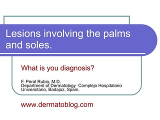 Lesions involving the palms and soles. What is you diagnosis? F. Peral Rubio, M.D. Department of Dermatology  Complejo Hospitalario Universitario, Badajoz, Spain. www.dermatoblog.com 