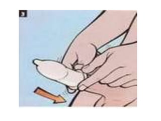 como poner un condon