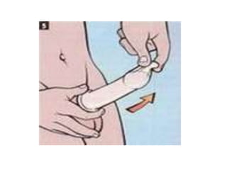 como poner un condon