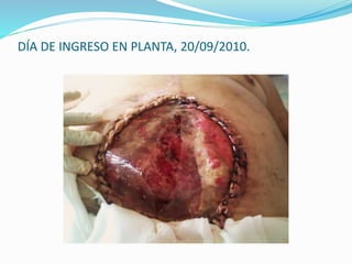 DÍA DE INGRESO EN PLANTA, 20/09/2010.
 