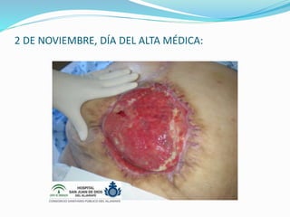 2 DE NOVIEMBRE, DÍA DEL ALTA MÉDICA:
 