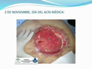 2 DE NOVIEMBRE, DÍA DEL ALTA MÉDICA:
 