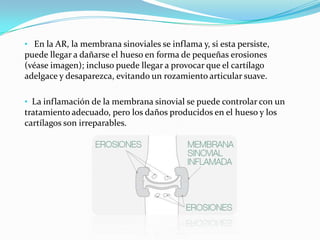   La inflamación de la membrana sinovial se puede controlar con un tratamiento adecuado, pero los daños producidos en el h...