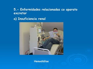 5.- Enfermidades relacionadas co aparato excretor a) Insuficiencia renal Hemodiálise 
