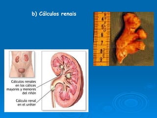 b) Cálculos renais 