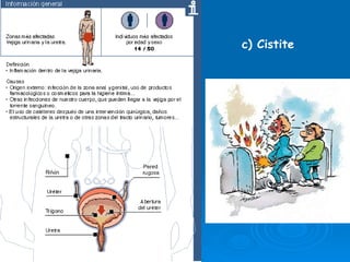 c) Cistite 