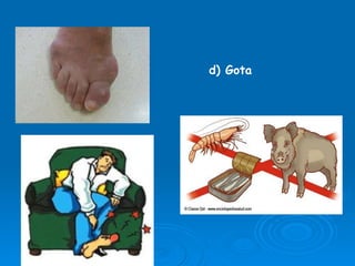 d) Gota 