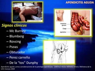 Apendicitis Aguda | PPTX