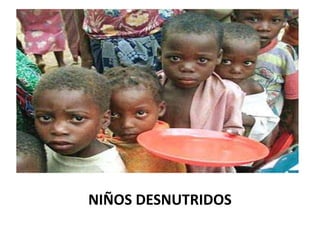 NIÑOS DESNUTRIDOS
 