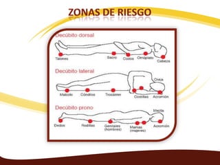 CUIDADO DE LA PIEL DE PACIENTES ENCAMADOS