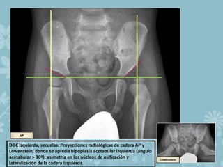 Lowenstein Rx Radiodiagnostico de enfermedades de caderas en niños | PPTX