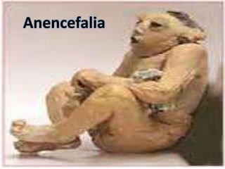 Anencefalia

 