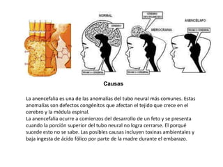 Causas
La anencefalia es una de las anomalías del tubo neural más comunes. Estas
anomalías son defectos congénitos que afectan el tejido que crece en el
cerebro y la médula espinal.
La anencefalia ocurre a comienzos del desarrollo de un feto y se presenta
cuando la porción superior del tubo neural no logra cerrarse. El porqué
sucede esto no se sabe. Las posibles causas incluyen toxinas ambientales y
baja ingesta de ácido fólico por parte de la madre durante el embarazo.

 