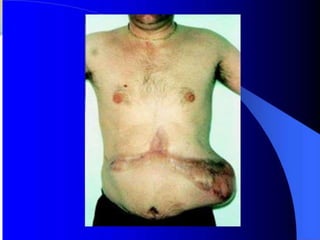 Pancreatitis, enfermedad inflamatoria del páncreas
que agrupa diferentes procesos agudos y crónicos.

 