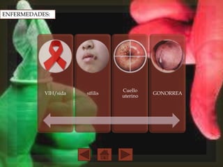ENFERMEDADES:
VIH/sida
sífilis
Cuello
uterino
GONORREA