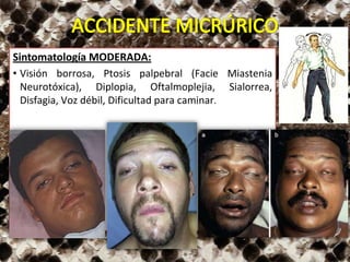 Sintomatología MODERADA:
• Visión borrosa, Ptosis palpebral (Facie Miastenia
Neurotóxica), Diplopia, Oftalmoplejia, Sialorrea,
Disfagia, Voz débil, Dificultad para caminar.
 