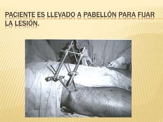 PACIENTE ES LLEVADO A PABELLÓN PARA FIJAR
LA LESIÓN.
 
