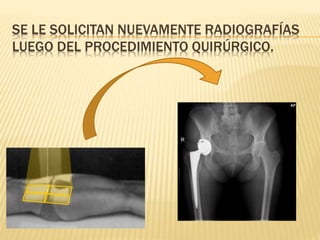 SE LE SOLICITAN NUEVAMENTE RADIOGRAFÍAS
LUEGO DEL PROCEDIMIENTO QUIRÚRGICO.
 