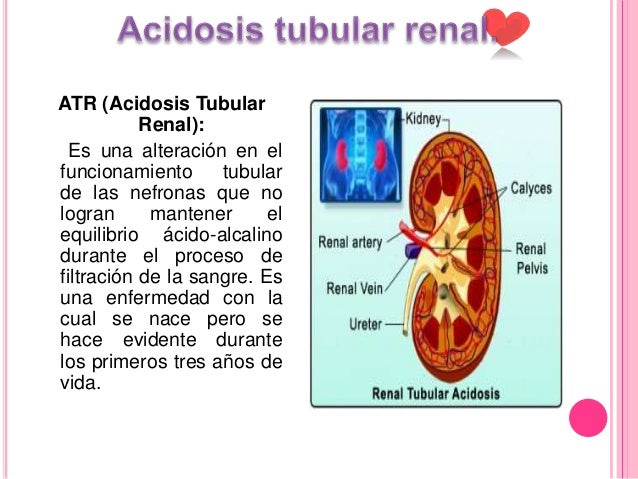 Acidosis Tubular Renal