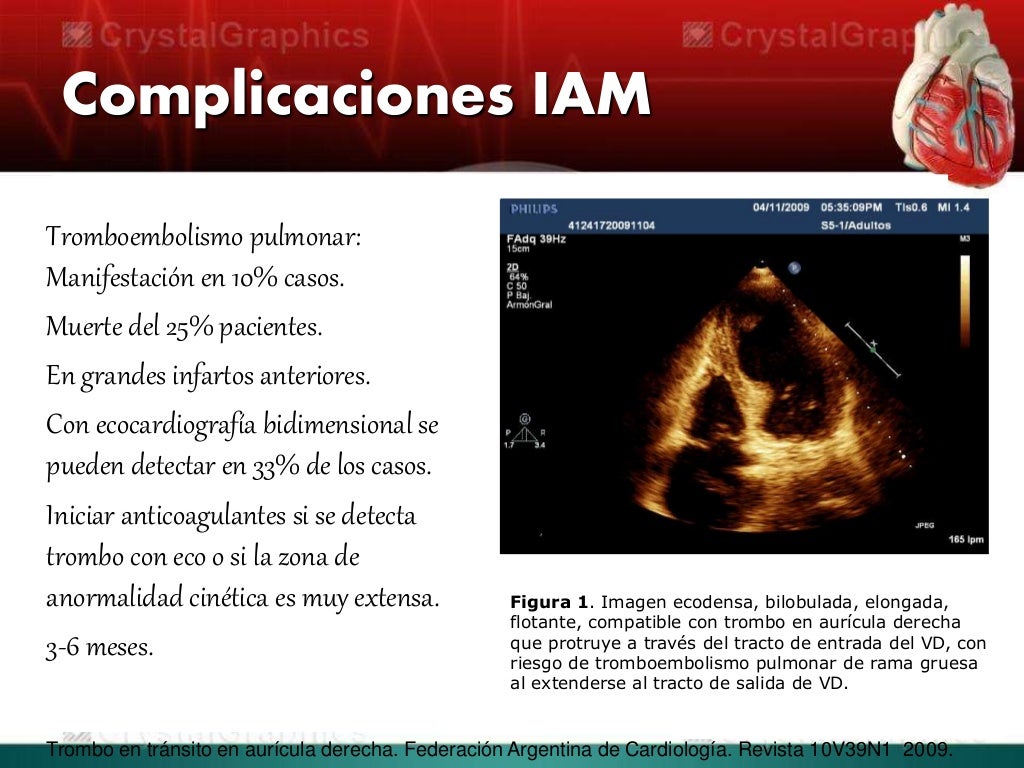 Infarto agudo del miocardio