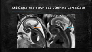 Etiología más común del Síndrome Cerebeloso
 