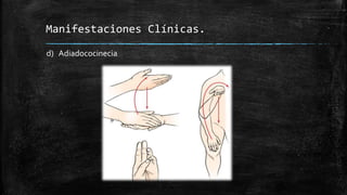 d) Adiadococinecia
Manifestaciones Clínicas.
 