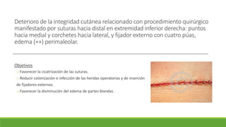 Deterioro de la integridad cutánea relacionado con procedimiento quirúrgico
manifestado por suturas hacia distal en extremidad inferior derecha: puntos
hacia medial y corchetes hacia lateral, y fijador externo con cuatro púas,
edema (++) perimaleolar.
Objetivos
o Favorecer la cicatrización de las suturas.
o Reducir colonización e infección de las heridas operatorias y de inserción
de fijadores externos.
o Favorecer la disminución del edema de partes blandas.
 