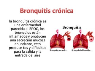 la bronquitis crónica es
una enfermedad
parecida al EPOC, los
bronquios están
inflamados y producen
una secreción mucosa
abundante, esto
produce tos y dificultad
para la salida y la
entrada del aire
 