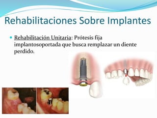 Rehabilitaciones Sobre Implantes
 Rehabilitación Unitaria: Prótesis fija
implantosoportada que busca remplazar un diente
perdido.
 