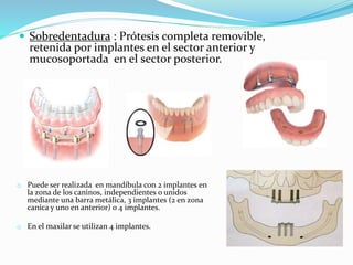  Sobredentadura : Prótesis completa removible,
retenida por implantes en el sector anterior y
mucosoportada en el sector posterior.
o Puede ser realizada en mandíbula con 2 implantes en
la zona de los caninos, independientes o unidos
mediante una barra metálica, 3 implantes (2 en zona
canica y uno en anterior) o 4 implantes.
o En el maxilar se utilizan 4 implantes.
 