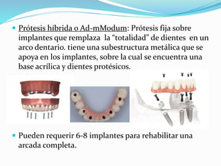  Prótesis híbrida o Ad-mModum: Prótesis fija sobre
implantes que remplaza la “totalidad” de dientes en un
arco dentario. tiene una subestructura metálica que se
apoya en los implantes, sobre la cual se encuentra una
base acrílica y dientes protésicos.
 Pueden requerir 6-8 implantes para rehabilitar una
arcada completa.
 