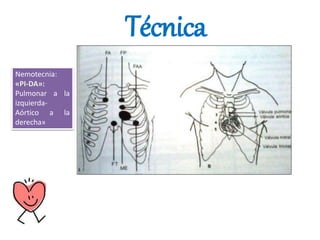 Técnica
Nemotecnia:
«PI-DA»:
Pulmonar a la
izquierda-
Aórtico a la
derecha»
 