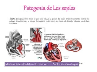 Patogenia de Los soplos
Soplo funcional: Se debe a que una válvula a pesar de estar anatómicamente normal no
ocluye (insuficiencia) u ocluye demasiado (estenosis), es decir, el defecto valvular es de tipo
funcional.
Mediana intensidad+fremitos rara vez ……. Soplos sistolicos largos
 