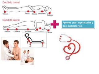 Apneas pos- espiratorias y
pos-inspiratorias.
 