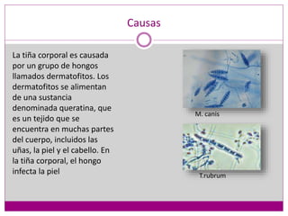Causas
La tiña corporal es causada
por un grupo de hongos
llamados dermatofitos. Los
dermatofitos se alimentan
de una sustancia
denominada queratina, que
es un tejido que se
encuentra en muchas partes
del cuerpo, incluidos las
uñas, la piel y el cabello. En
la tiña corporal, el hongo
infecta la piel
M. canis
T.rubrum
 