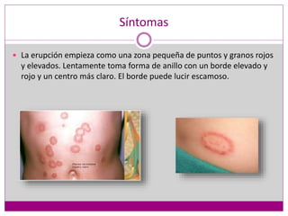Síntomas
 La erupción empieza como una zona pequeña de puntos y granos rojos
y elevados. Lentamente toma forma de anillo con un borde elevado y
rojo y un centro más claro. El borde puede lucir escamoso.
 