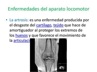 Enfermedades del aparato locomotor
• La artrosis: es una enfermedad producida por
el desgaste del cartílago, tejido que hace de
amortiguador al proteger los extremos de
los huesos y que favorece el movimiento de
la articulación.
 