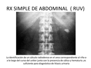 RX SIMPLE DE ABDOMINAL ( RUV)
La identificación de un cálculo radiodenso en el area correspondiente al riño o
a lo largo del curso del uréter junto con la presencia de cólico y hematuria ,es
suficiente para diagnóstico de litiasis urinaria
 
