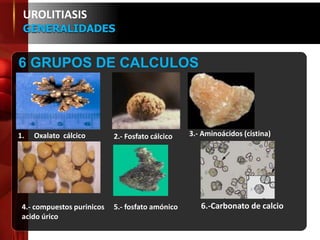 6 GRUPOS DE CALCULOS
UROLITIASIS
GENERALIDADES
6.-Carbonato de calcio
1. Oxalato cálcico 2.- Fosfato cálcico 3.- Aminoácidos (cistina)
4.- compuestos purinicos
acido úrico
5.- fosfato amónico
 
